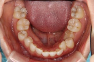 左下第二小臼歯が先天性欠如し乳歯が残っています